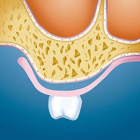 Interimsprothese (Hohlraum zwischen Kieferkamm Interimsprothese) | Protefix