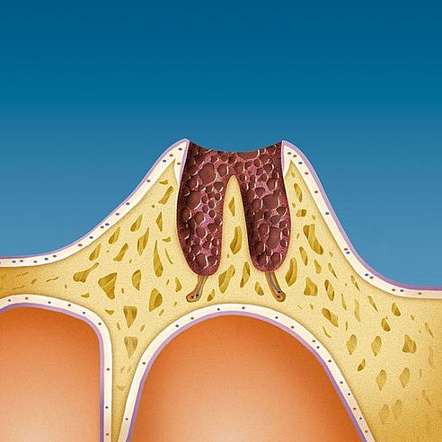 Als Folgen des Zahnverlustes entstehen im Kiefer tiefe Wunden | Protefix